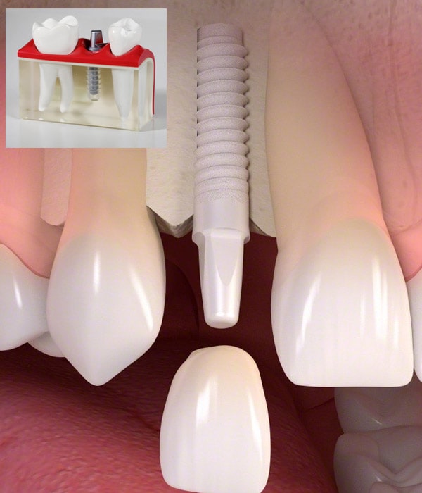 Implants
